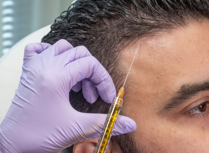 Nærbillede af en mand, der modtager en PRP-behandling i hovedbunden mod hårtab.